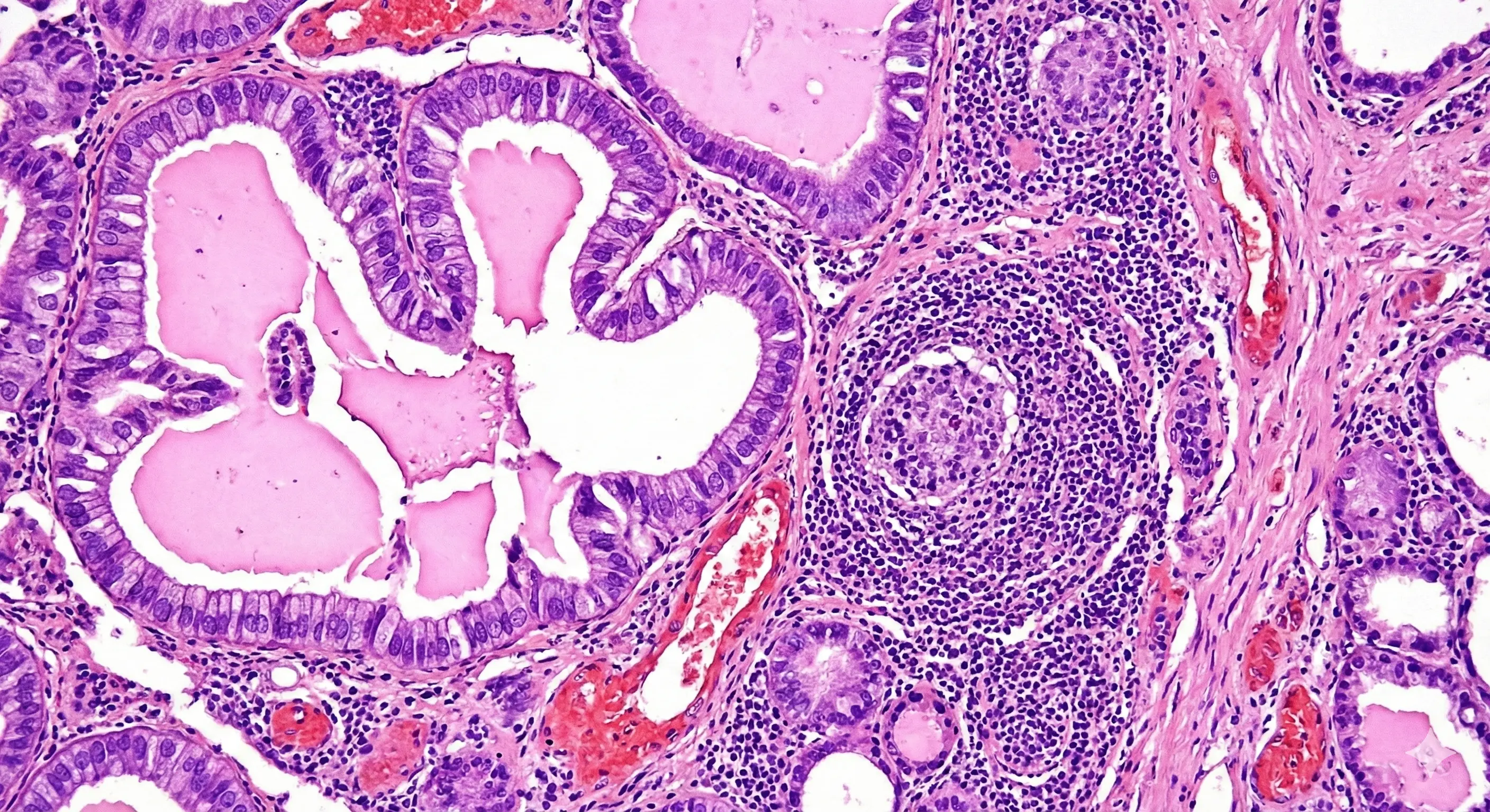 Thyroid Disorders
